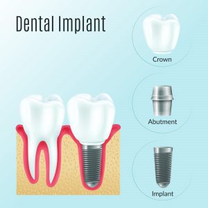 Image displaying the structure of a dental implant